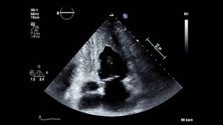 Endomyocardial Fibroelastosis [upl. by Okun]