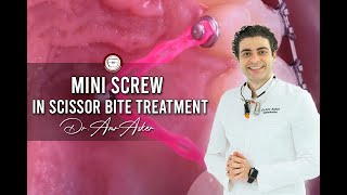 orthodontic mini screw in scissor bite treatment by Dr Amr Asker [upl. by Aissela]