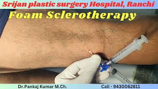 Varicose veins treatment with foam Sclerotherapy Varicose veins treatment for SSC GD medical test [upl. by Annal]