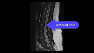 Lspine MRI Spinal Bifida with Tethered Cord [upl. by Giliane]