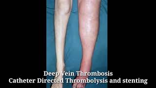 Deep Vein Thrombosis DVT  Treatment Catheter Directed Thrombolysis and stenting in Hyderabad [upl. by Farica]