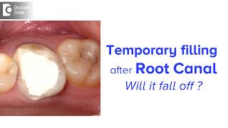 How long can you keep a temporary filling after root canal  Dr Chandan Mahesh [upl. by Chapel808]