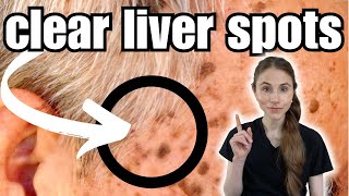 Get Rid Of Liver Spots FAST  Seborrheic Keratosis [upl. by Akiem]