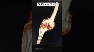 CT SCAN KNEE 3DMedical Anatomy CT [upl. by Whitford863]