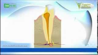 La Ciste Dentale o il Granuloma [upl. by Zumwalt129]