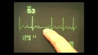 EKG ECG rhythms 4 Heart block rhythms [upl. by Aw167]