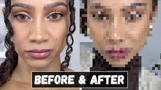 SEE THE LATEST RESULTS 3 Months after my Rhinoplasty Part 4 Tiana Peri [upl. by Loma]