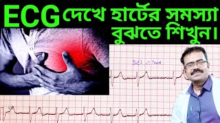 ECG দেখে হার্টের সমস্যা বুঝবেন কিভাবেHow to interpret ECGHow to read ECGElectrocardiogramECG [upl. by Haroppizt9]