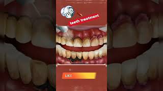 ASMR animation cleaning teeth with ultrasonic scaler shorts dentist teethcleaning short viral [upl. by Sargent663]