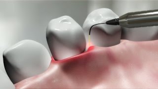 Laser Dental Treatment [upl. by Kirsteni321]