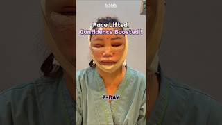 See My Dramatic Facelift Transformation [upl. by Barber]