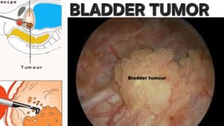 Bladder tumor treatment  intravesical BCG  Immunotherapy after bladder tumor operation [upl. by Kathy352]