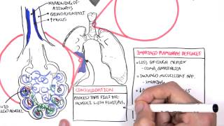 PART I  Pneumonia Overview Lobar and Bronchopneumonia [upl. by Justino]