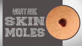 What are Skin Moles [upl. by Aietal]