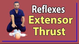 02 Extensor Thrust Reflex [upl. by Ecinert]