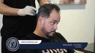 Hair Transplant Turkey  Medart Hair Istanbul [upl. by Colburn]