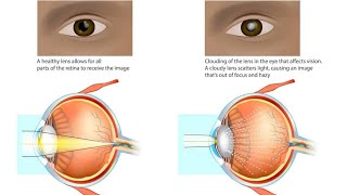 cataract kya hota hai motiyabind ka ilaj cataract ki surgery [upl. by Sethrida79]