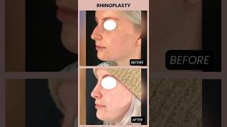 Rhinoplasty Result 👃🏼 rhinoplasty rhinoplastybeforeandafter nosejobs [upl. by Eded659]