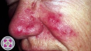 Laser Treatment for Rosacea amp Skin Redness [upl. by Zaria691]