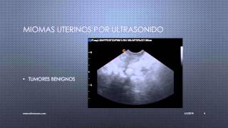 MIOMAS UTERINOS VISUALIZADOS POR ULTRASONIDO [upl. by Descombes79]