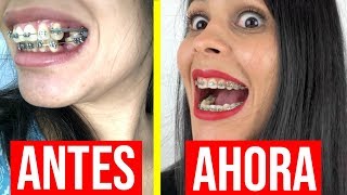 Me SACARON 7 MUELAS 🦷  La HISTORIA de mis BRACKETS [upl. by Amandi]