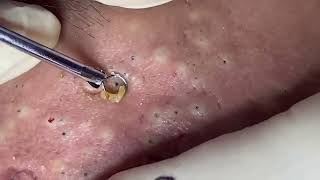 blackheads New this week 2023 [upl. by Nihs]