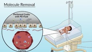 Peritoneal Dialysis by S Su A Olszewski  OPENPediatrics [upl. by Sherl]