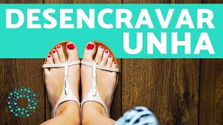 COMO DESENCRAVAR UNHA  remédios para unha encravada [upl. by Reivax]