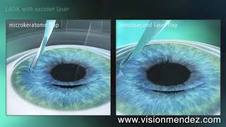 LASIK vs FEMTOLASIK [upl. by Alexei]