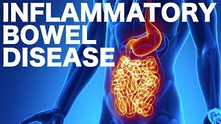 Ulcerative Colitis vs Crohns Disease PANCE review [upl. by Hnim]