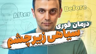 سیاهی و گودی زیر چشم را چگونه از بین ببریم؟  How to get rid of under eye dark circles [upl. by Akeihsal]