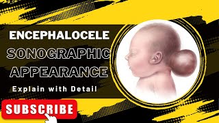 Encephalocele explain the sonographic appearance and How it shows on ultrasound [upl. by Aelahs29]