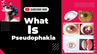 What is pseudophakiasign of pseudophakia symptoms of pseudophakia psedophekic eye ophthalmic [upl. by Neelac]