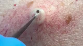 3min Best Blackhead Removal Ever 2024 [upl. by Idnac114]