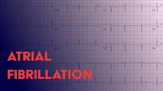 Atrial Fibrillation Afib  EKG ECG Interpretation [upl. by Peednam604]