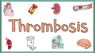 Thrombosis  Definition Causes Types Morphology Fate of a Thrombus amp Clinical manifestations [upl. by Tolman]