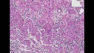 Histopathology Esophagus Herpes esophagitis [upl. by Omora]