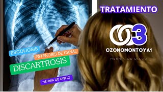 EscoliosisDiscartrosis y Hernias de disco múltiples con estenosis de canal tratamiento [upl. by Junie]