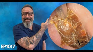 LONG EAR WAX PLUGS DEEP EAR WAX REMOVAL AND SKIN REMOVAL  EP1017 [upl. by Karl]