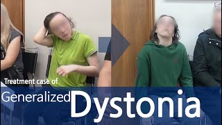 Dystonia  Generalized Dystonia  사경증  전신사경증 [upl. by Wina24]