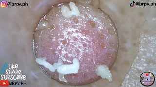 PORE VACUUM BLACKHEAD REMOVAL DEMO FOR Week32 CLASSICAL MUSIC brpvph​satisfying [upl. by Alfred559]