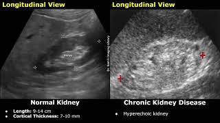 Kidney Ultrasound Normal Vs Chronic Kidney Disease CKD Imaging Findings  Chronic Renal Failure [upl. by Joung495]