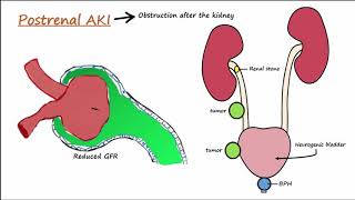 Acute Kidney Injury AKI  PrerenalIntrarenalPostrenal [upl. by Ecirtaeb772]