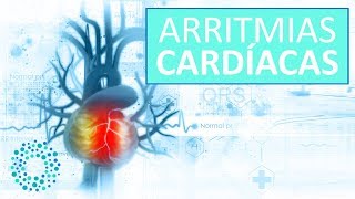 ARRITMIAS CARDIACAS – Síntomas y Tratamientos Arritmias [upl. by Auric]