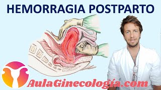 HEMORRAGIA POSTPARTO CAUSAS y TRATAMIENTOS que pueden SALVAR VIDAS  Ginecología y Obstetricia [upl. by Sandro]