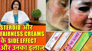 Steroid और Fairness Creams के Side Effects और उनका इलाज [upl. by Abdulla743]