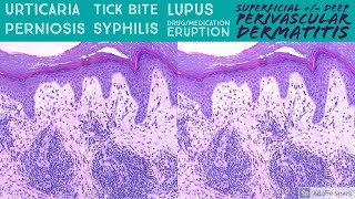 Urticaria Tick Bite Syphilis Lupus Perniosis etc Perivascular Dermatitis Pattern Dermpath [upl. by Haeli811]