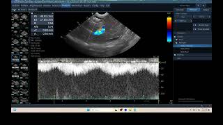 IQ 330 HEPATIC VEIN portal vein shunt ECHOPAC ANALYSIS ULTRASOUND [upl. by Nalhsa308]