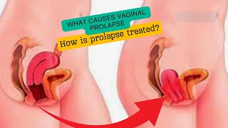 What causes vaginal prolapse [upl. by Indyc]