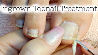 Pedicure Tutorial Ingrown Toenail Treatment At Home How to Recut Nail Groove to Eliminate Pain [upl. by Sprague]